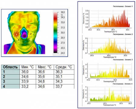 Термограмма лица во фронтальной проекции