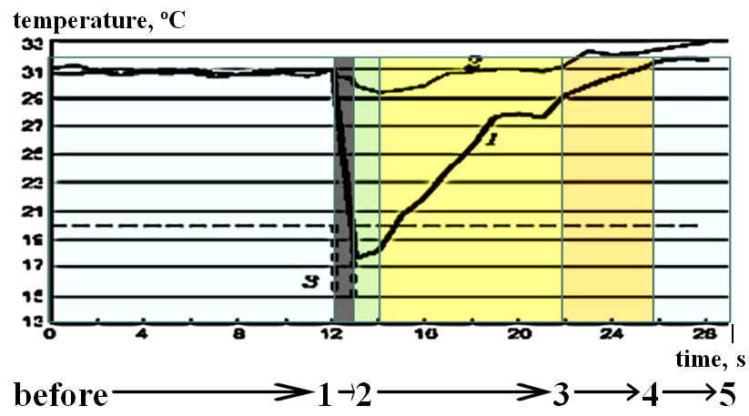 A typical curve of the IR radiation dynamics in response to a standardized cold test in the stimulated (1) and symmetric non-stimulated (2) areas of the skin on the fingers (in healthy participants). Shift on line 3 represents refrigerant exposure time on the stimulation.
