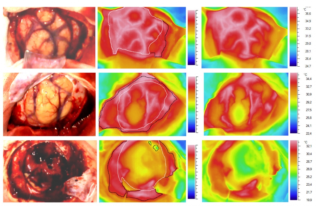 Variants of the 2-minute temperature dynamics of the open cortex in response to a standardized cold test. The top row is "compensation", the middle row is "subcompensation", the lower row is "decompensation". The left column: photographs of the examined area. The middle column: the thermal images, where the white contour is the projection of the tumor on the surface of the cortex, the black contour is the "working zone" (cortex + dura mater). The right column: the temperature scale for each case.